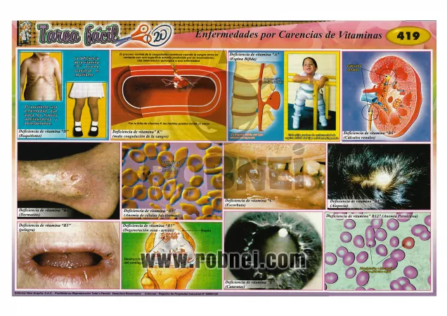 Enfermedades Por Carencia De Vitaminas
